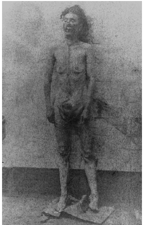 Fotograf&iacute;a del cad&aacute;ver de Catherine&nbsp;Eddowes (1842-1888), v&iacute;ctima can&oacute;nica&nbsp;de Jack el Destripador en la morgue, tras&nbsp;el examen m&eacute;dico del cuerpo. Como puede&nbsp;verse, en este caso el inter&eacute;s est&eacute;tico ha&nbsp;desaparecido por completo, siendo la finalidad&nbsp;de la toma meramente informativo (Royal
London Hospital Archives and Museum,&nbsp;Londres, Reino Unido).
